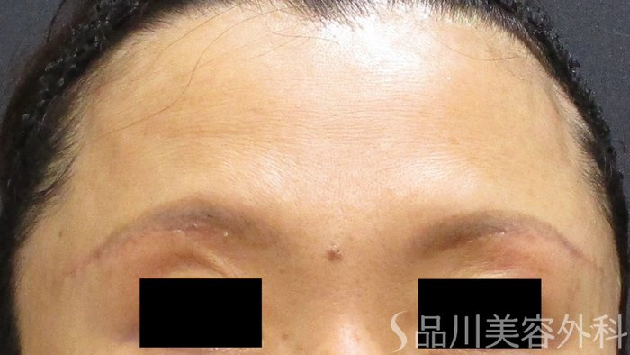 症例NO.65587のAFTER写真