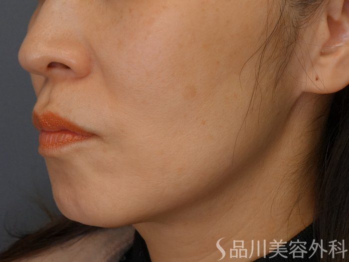 症例NO.69436のBEFORE写真