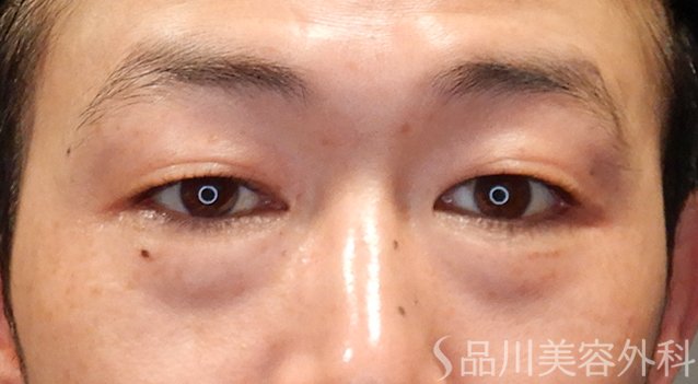 症例NO.74900のBEFORE写真