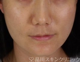 症例NO.71655のAFTER写真