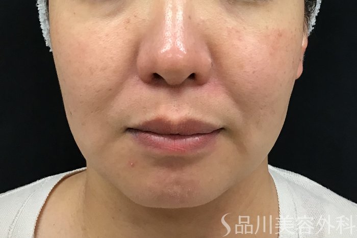 症例NO.63227のBEFORE写真