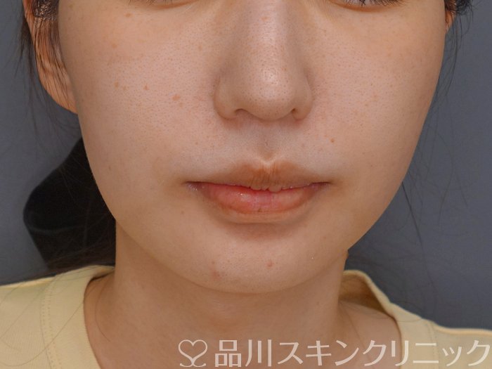 症例NO.73786のBEFORE写真