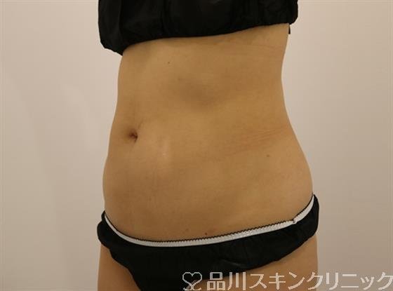 症例NO.43671のAFTER写真