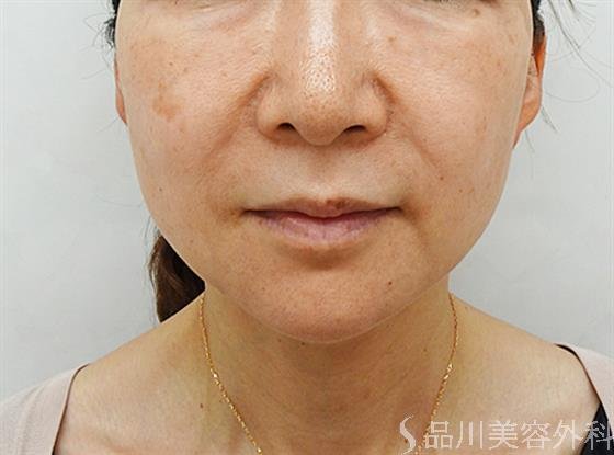症例NO.44611のBEFORE写真