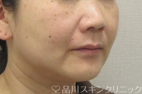 症例NO.74163のBEFORE写真