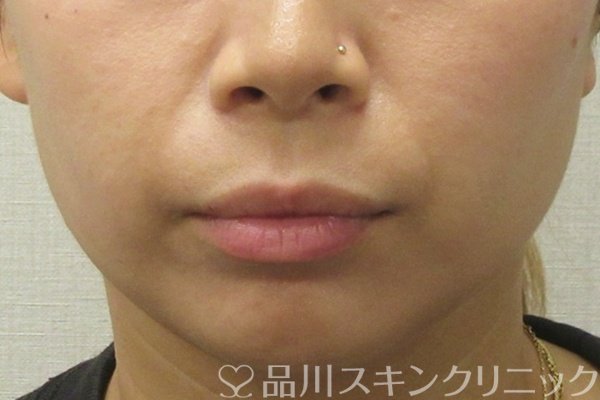 症例NO.74505のBEFORE写真
