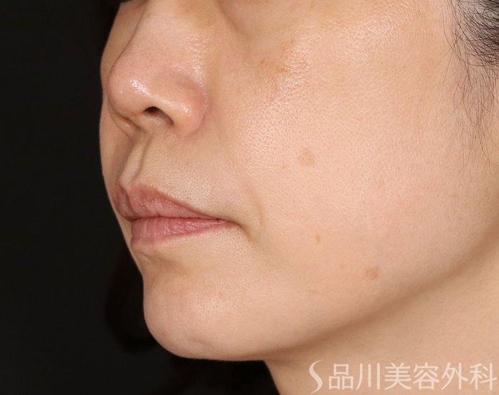 症例NO.71687のBEFORE写真
