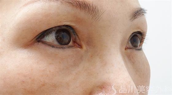 症例NO.52110のAFTER写真
