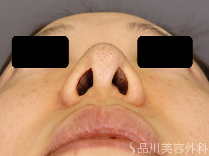 症例NO.72520のAFTER写真