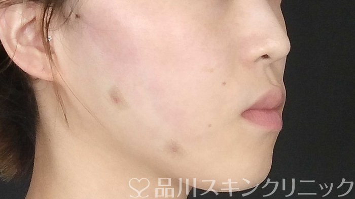 症例NO.71414のAFTER写真
