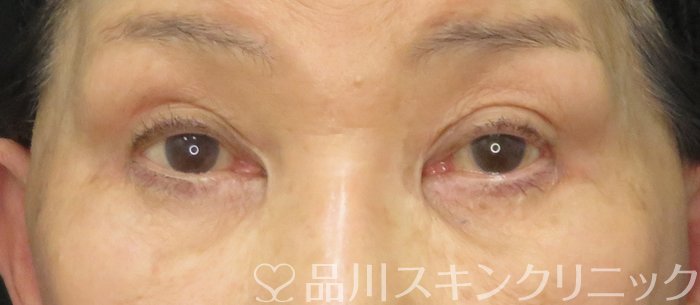 症例NO.73108のBEFORE写真