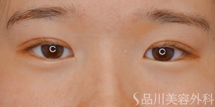 症例NO.73733のAFTER写真