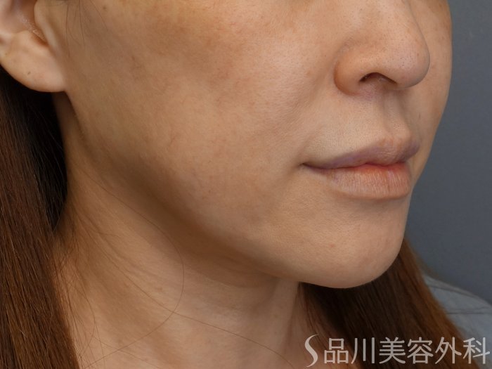 症例NO.71520のBEFORE写真