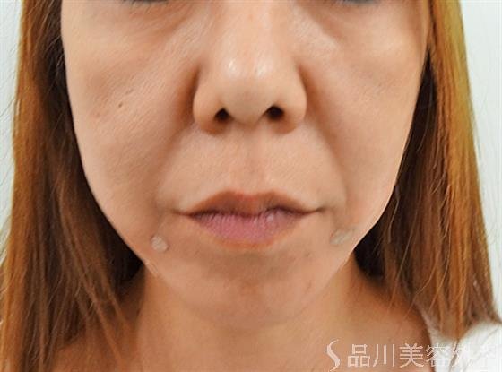 症例NO.25029のAFTER写真