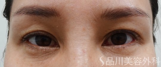 症例NO.74744のBEFORE写真