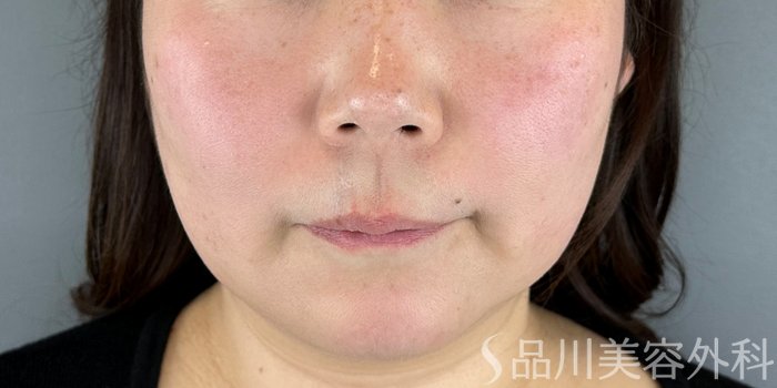 症例NO.70810のBEFORE写真