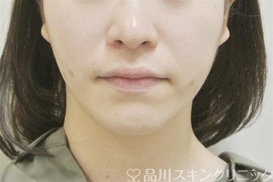 症例NO.30826のAFTER写真