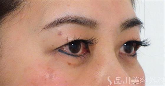症例NO.47297のBEFORE写真