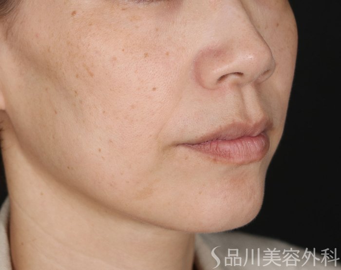 症例NO.72123のBEFORE写真