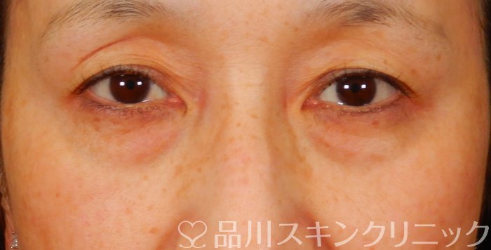 症例NO.68037のBEFORE写真