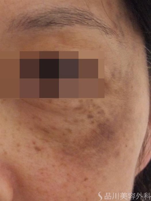 症例NO.22911のBEFORE写真