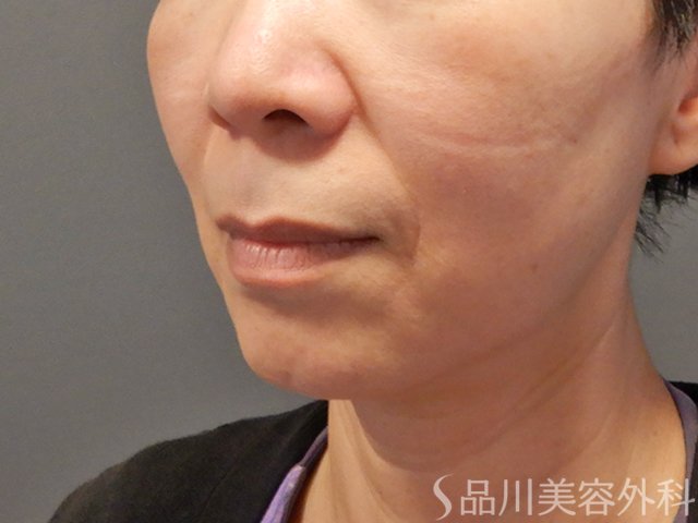 症例NO.74312のBEFORE写真