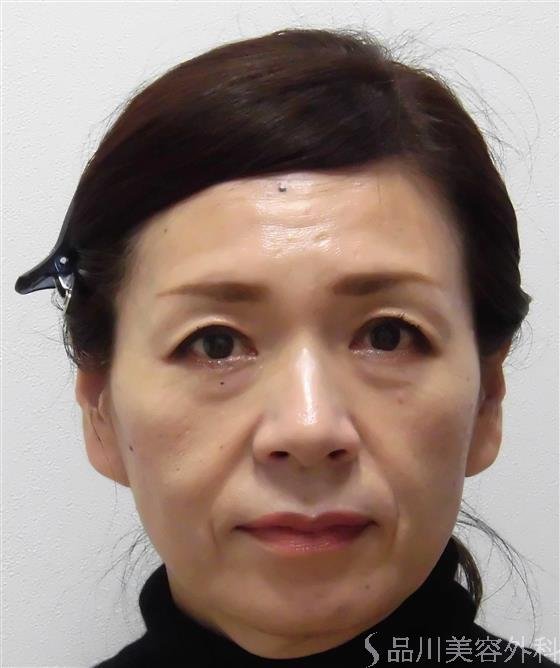 症例NO.25264のBEFORE写真