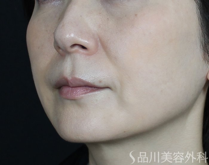 症例NO.72095のBEFORE写真