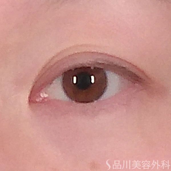 症例NO.69589のBEFORE写真