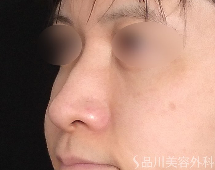 症例NO.70649のBEFORE写真