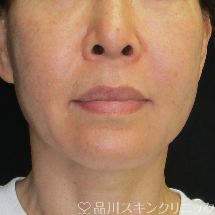症例NO.65561のBEFORE写真