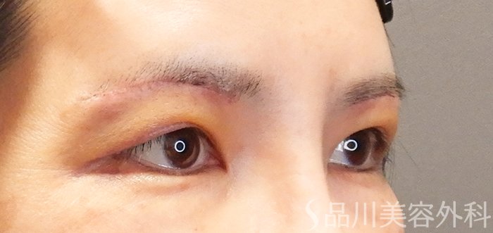 症例NO.67762のAFTER写真