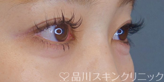 症例NO.72532のAFTER写真