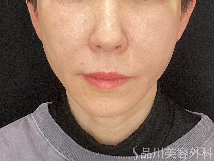 症例NO.72902のAFTER写真