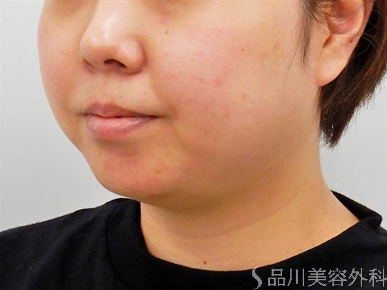 症例NO.52503のBEFORE写真