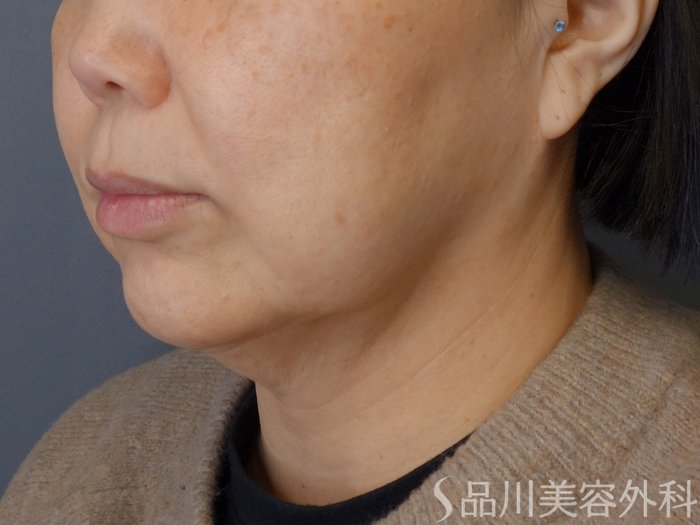 症例NO.72667のBEFORE写真