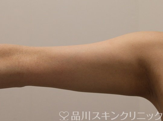 症例NO.71754のAFTER写真