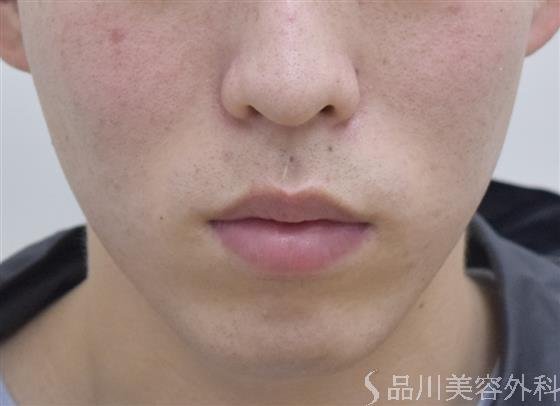 症例NO.47917のBEFORE写真