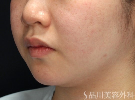 症例NO.70961のBEFORE写真