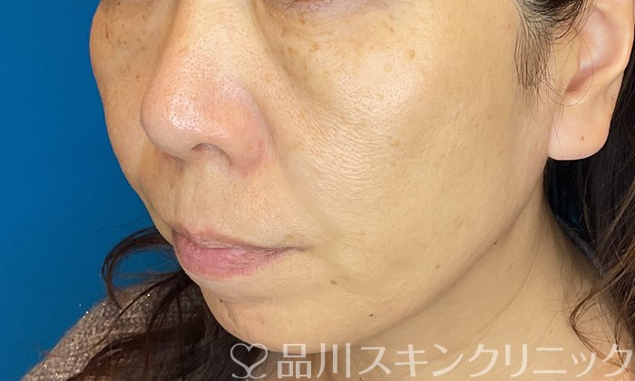 症例NO.73791のAFTER写真