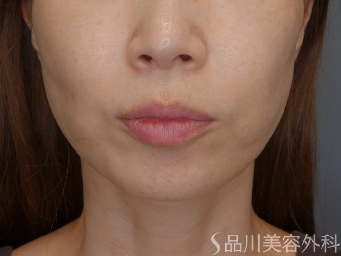 症例NO.71335のBEFORE写真
