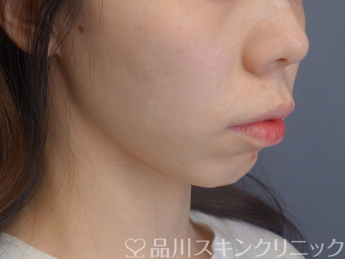 症例NO.74550のAFTER写真