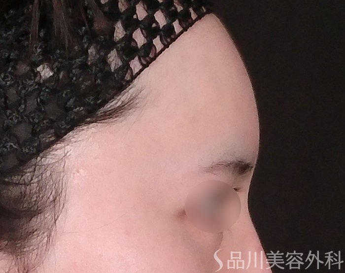 症例NO.69663のBEFORE写真