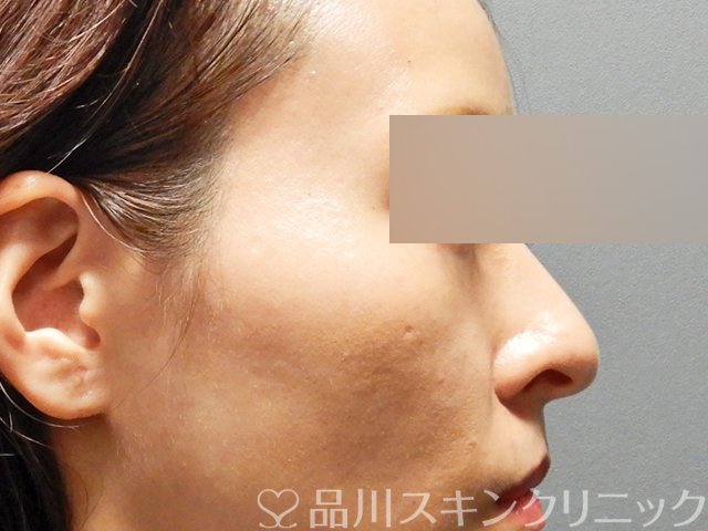 症例NO.67974のBEFORE写真