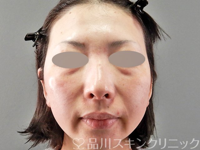 症例NO.63025のAFTER写真