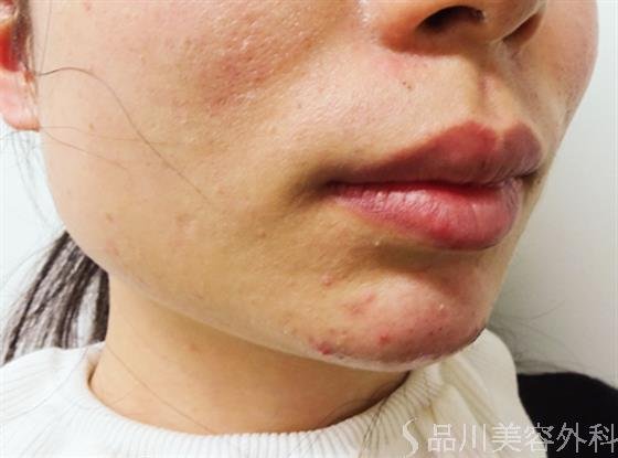 症例NO.33010のAFTER写真
