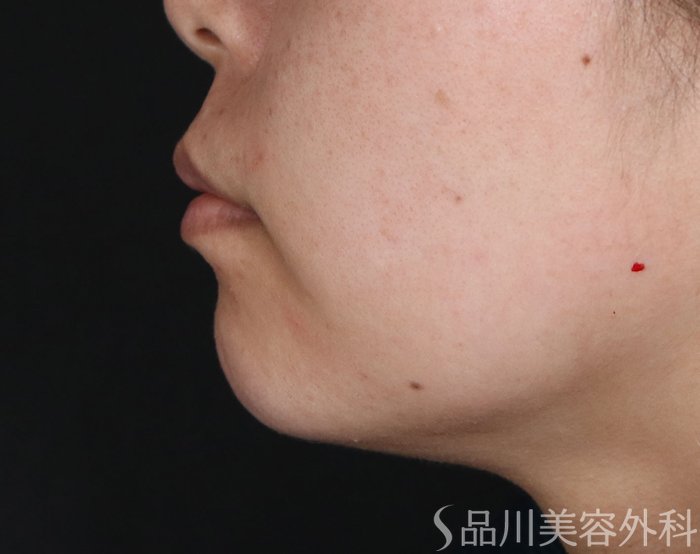 症例NO.73615のAFTER写真