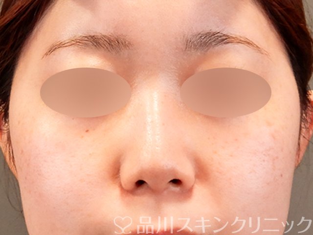 症例NO.69913のAFTER写真