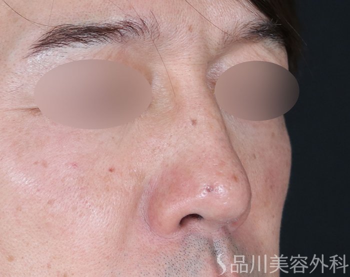 症例NO.72309のBEFORE写真