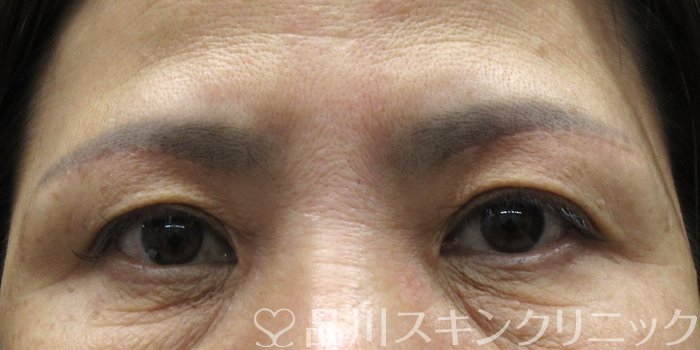 症例NO.70559のAFTER写真